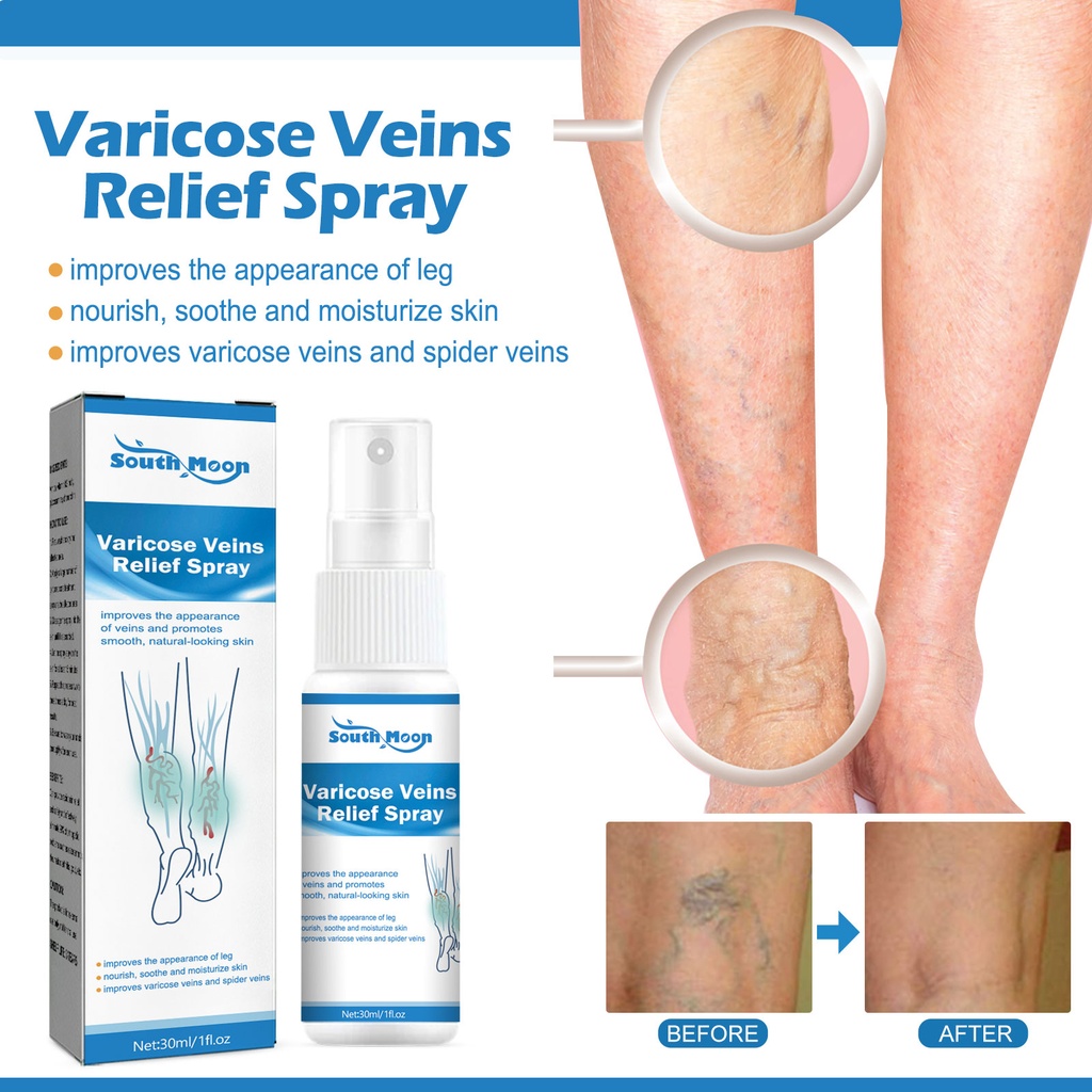 South Moon Varicose Veins Relief Spray, Varicose Repair Soreness And Swelling Body Care To Relieve Earthworm Legs Massage Spray