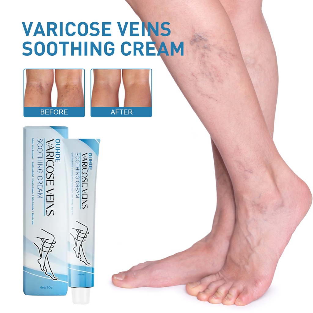 OUHOE Vein Repair Cream, Massage Legs Relieve Leg Pain Varicose Veins Treatment Cream